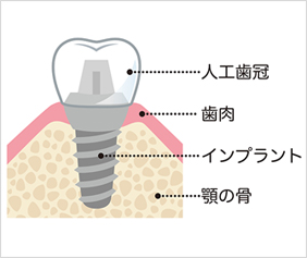 インプラントの仕組み