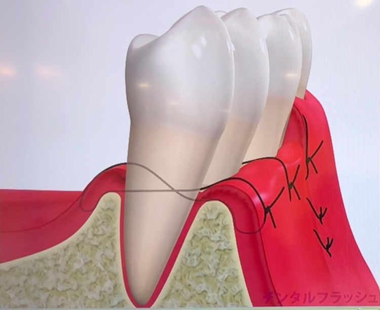 歯肉弁根尖側移動術
